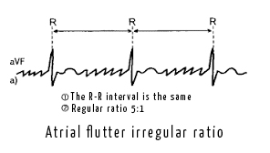 Atrial flutter.jpg