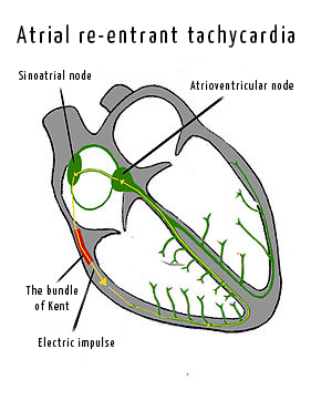 paroxysmal atrial flutter icd 10