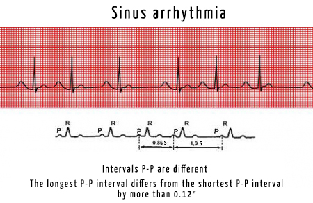 what causes sinus arrhythmia in dogs