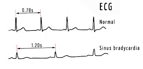 Sinus bradycardia.jpg