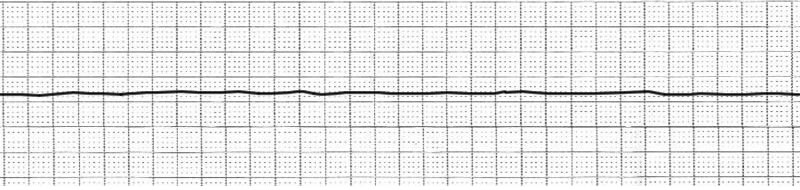 Asystole.jpg