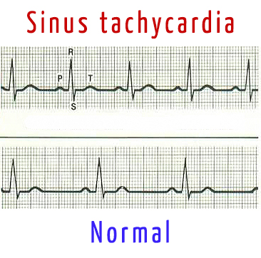 sinus tachycardia