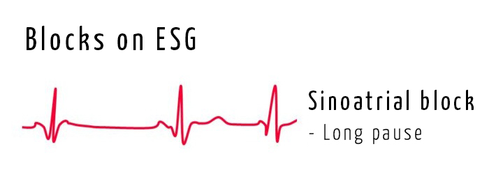 Sinoatrial block.jpg