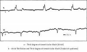 Third-degre or complete atrioventricular block.jpg