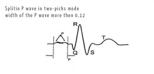 Intraatrial block.jpg