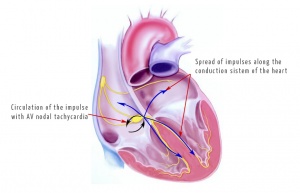 Atrioventricular nodal re-entrant tachycardia.jpg