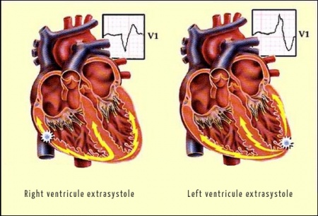 Ventricular extrasystoles (premature ventricular contractions) - CardioWiki