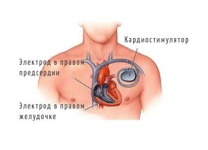 Кардиостимулятор.jpg