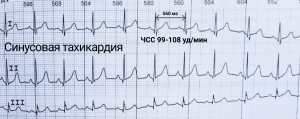 Sinusovaya-tahikardiya-na-ekg.png